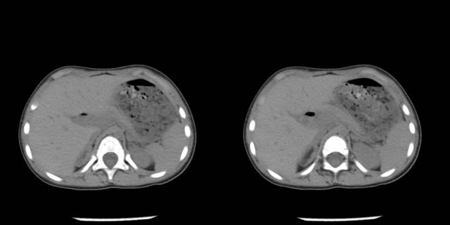 【病例】先天性肾上腺皮质增生症1例CT 【病例】先天性肾上腺皮质增生症1例CT