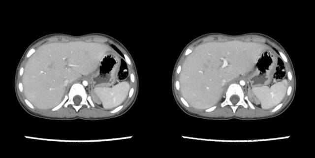 【病例】先天性肾上腺皮质增生症1例CT 【病例】先天性肾上腺皮质增生症1例CT