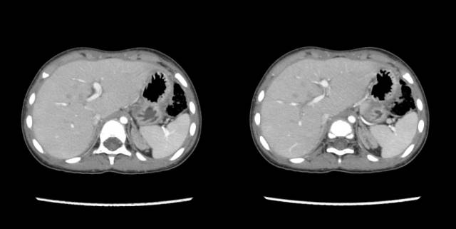 【病例】先天性肾上腺皮质增生症1例CT 【病例】先天性肾上腺皮质增生症1例CT