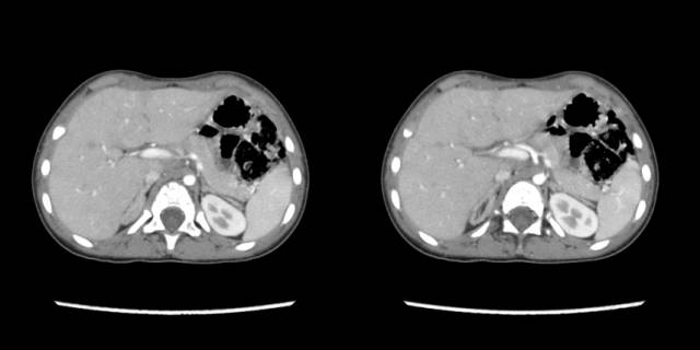 【病例】先天性肾上腺皮质增生症1例CT 【病例】先天性肾上腺皮质增生症1例CT