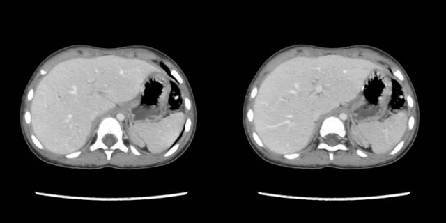 【病例】先天性肾上腺皮质增生症1例CT