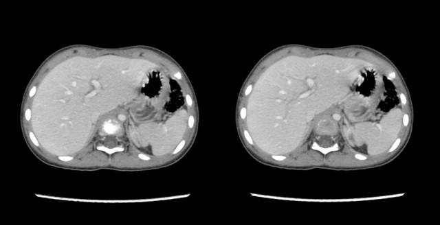 【病例】先天性肾上腺皮质增生症1例CT 【病例】先天性肾上腺皮质增生症1例CT