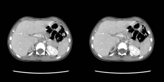 【病例】先天性肾上腺皮质增生症1例CT 【病例】先天性肾上腺皮质增生症1例CT
