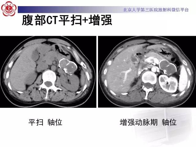 【病例】胰腺实性假乳头状瘤1例CT及MR