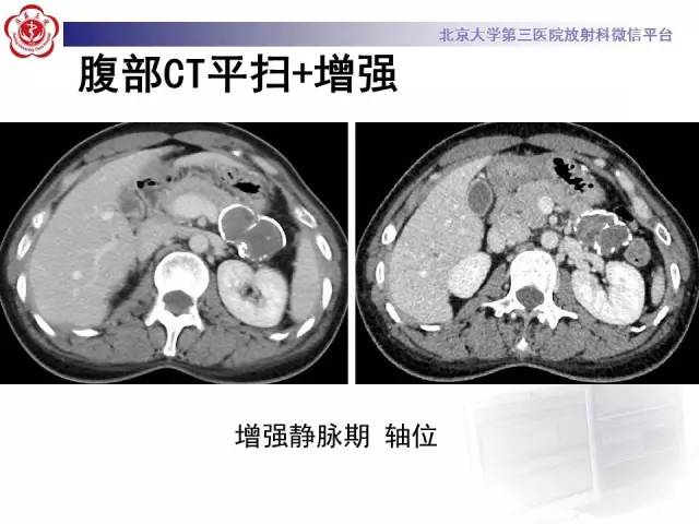 【病例】胰腺实性假乳头状瘤1例CT及MR