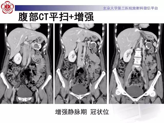【病例】胰腺实性假乳头状瘤1例CT及MR