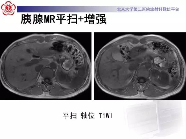 【病例】胰腺实性假乳头状瘤1例CT及MR