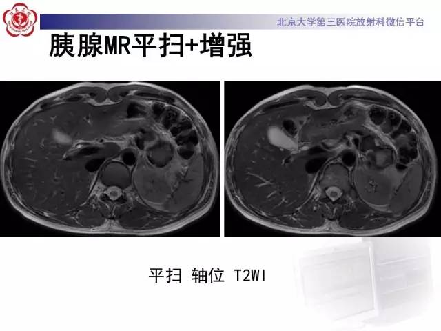 【病例】胰腺实性假乳头状瘤1例CT及MR