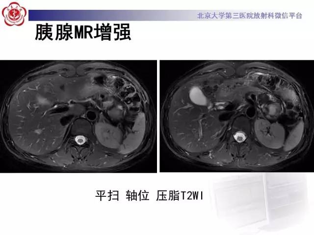 【病例】胰腺实性假乳头状瘤1例CT及MR