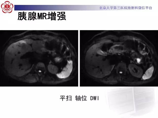 【病例】胰腺实性假乳头状瘤1例CT及MR