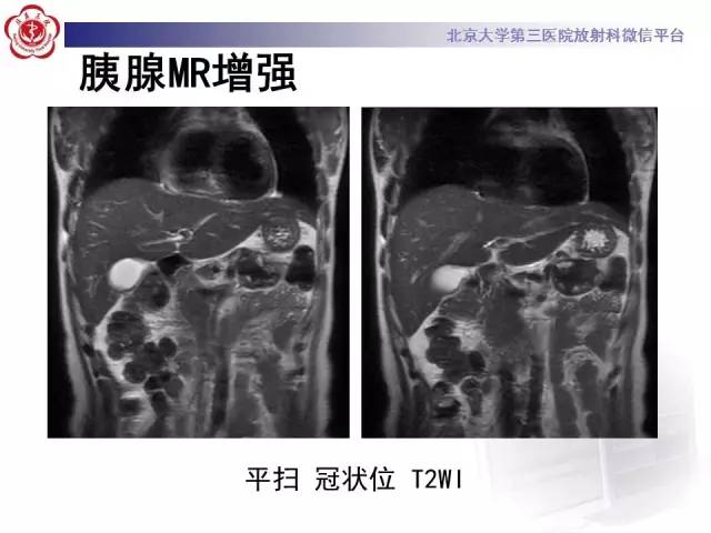 【病例】胰腺实性假乳头状瘤1例CT及MR