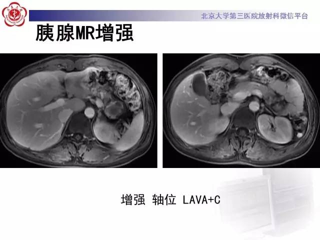 【病例】胰腺实性假乳头状瘤1例CT及MR
