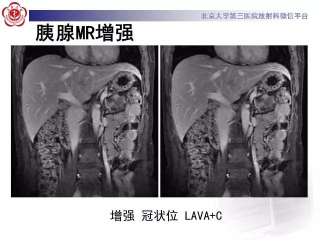 【病例】胰腺实性假乳头状瘤1例CT及MR