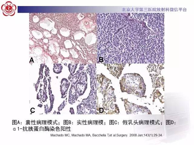 【病例】胰腺实性假乳头状瘤1例CT及MR
