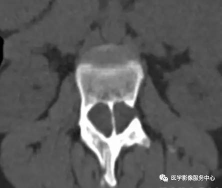 【病例】脊髓纵裂1例