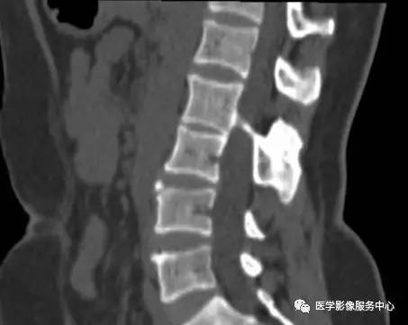 【病例】脊髓纵裂1例 【病例】脊髓纵裂1例