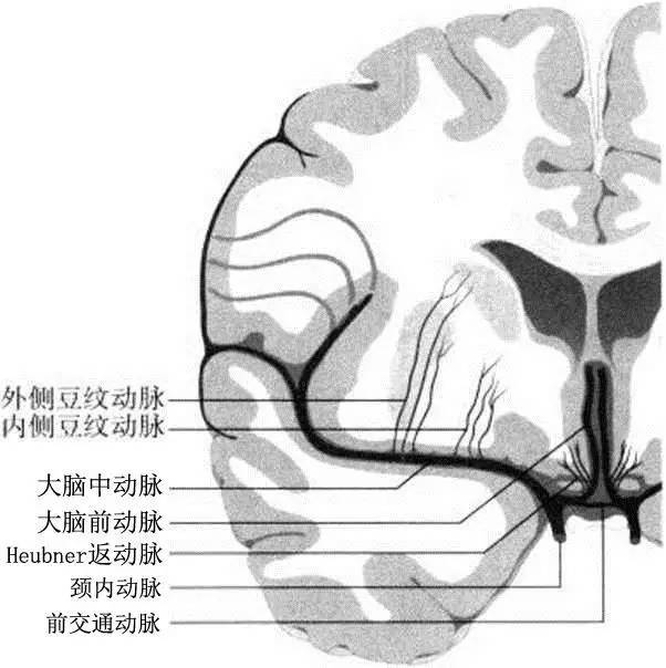 脑血管病之豆纹动脉病变影像学识别