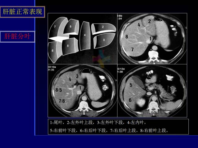 【PPT】常见肝胆胰腺疾病的CT(全)