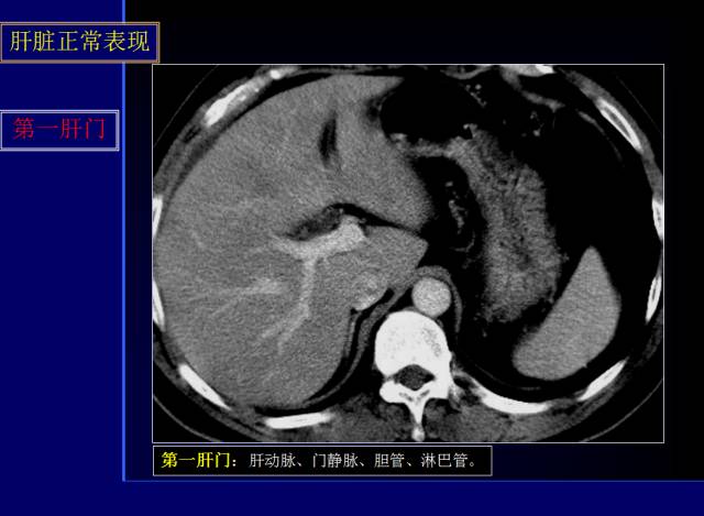 【PPT】常见肝胆胰腺疾病的CT(全)