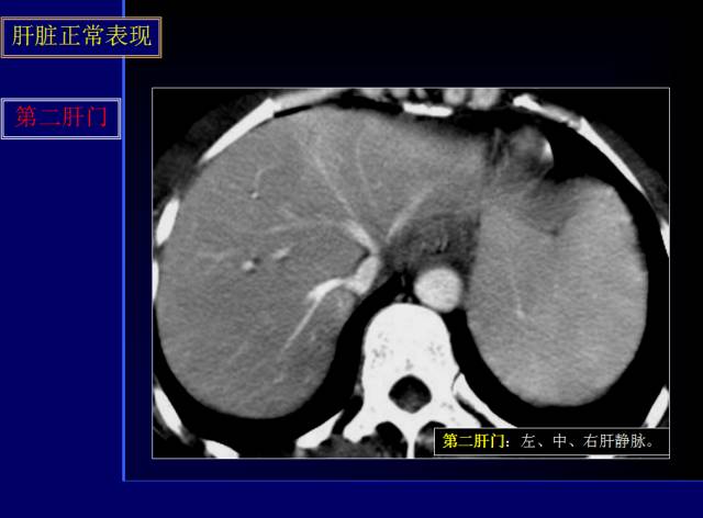 【PPT】常见肝胆胰腺疾病的CT(全)
