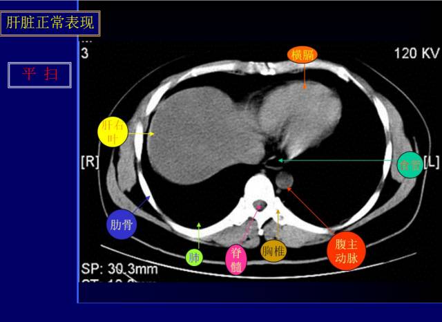 【PPT】常见肝胆胰腺疾病的CT(全)
