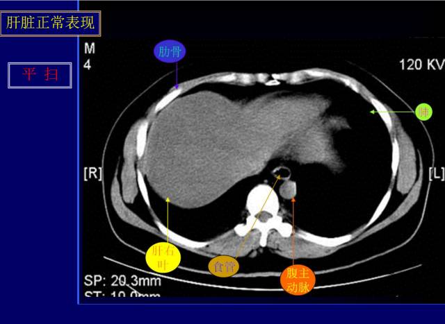 【PPT】常见肝胆胰腺疾病的CT(全)
