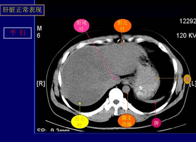 【PPT】常见肝胆胰腺疾病的CT(全)