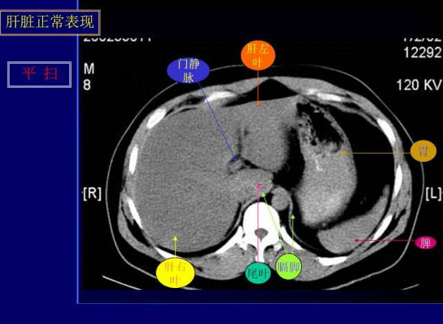 【PPT】常见肝胆胰腺疾病的CT(全)