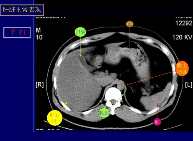 【PPT】常见肝胆胰腺疾病的CT(全)