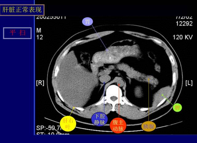 【PPT】常见肝胆胰腺疾病的CT(全)