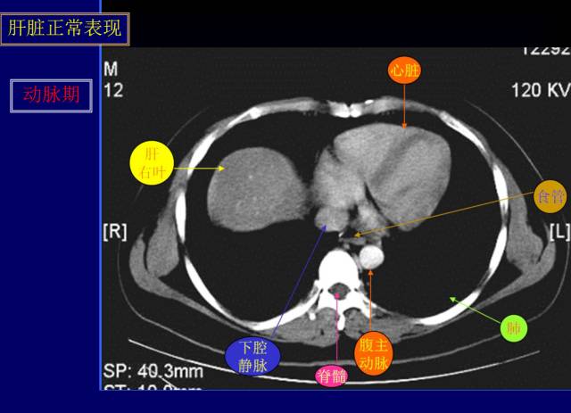 【PPT】常见肝胆胰腺疾病的CT(全)