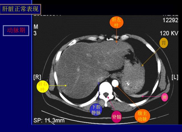 【PPT】常见肝胆胰腺疾病的CT(全)