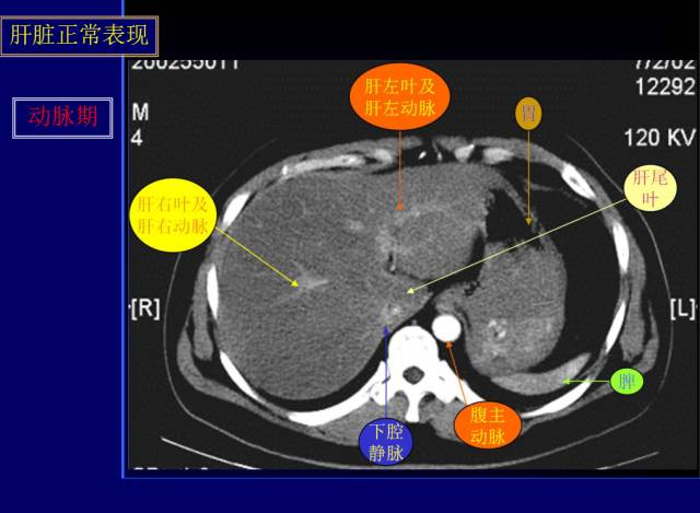 【PPT】常见肝胆胰腺疾病的CT(全)