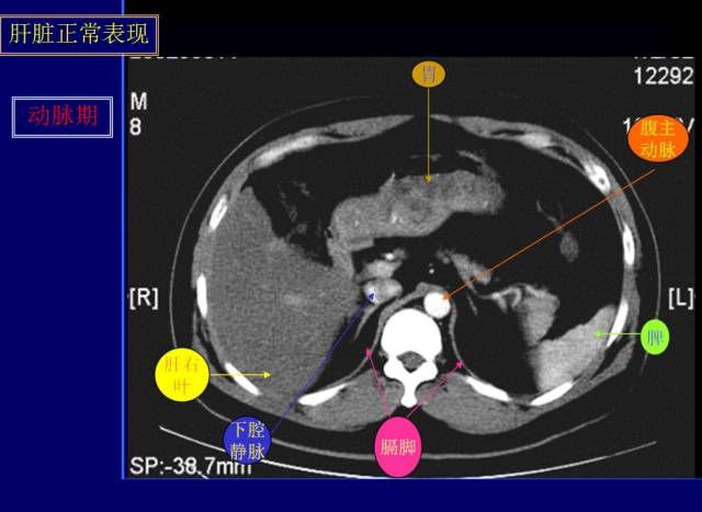【PPT】常见肝胆胰腺疾病的CT(全)