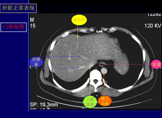 【PPT】常见肝胆胰腺疾病的CT(全)