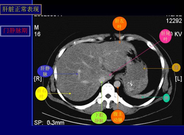 【PPT】常见肝胆胰腺疾病的CT(全)