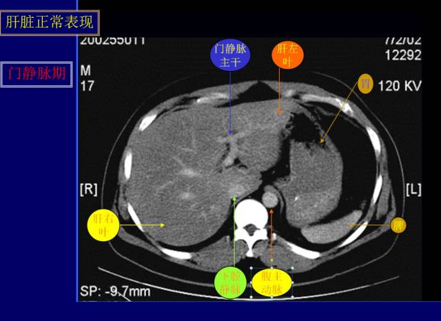 【PPT】常见肝胆胰腺疾病的CT(全)