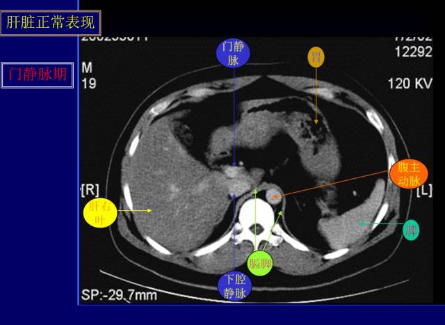 【PPT】常见肝胆胰腺疾病的CT(全)