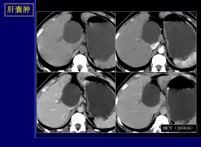 【PPT】常见肝胆胰腺疾病的CT(全)