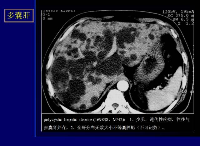 【PPT】常见肝胆胰腺疾病的CT(全)