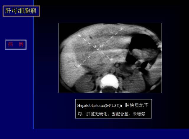 【PPT】常见肝胆胰腺疾病的CT(全)
