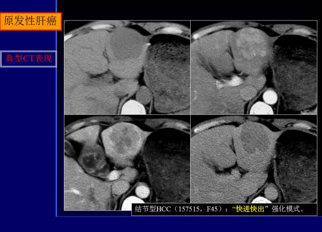 【PPT】常见肝胆胰腺疾病的CT(全)