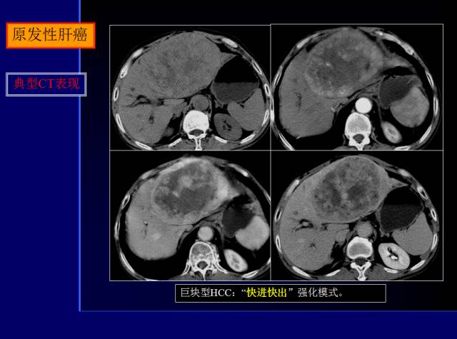 【PPT】常见肝胆胰腺疾病的CT(全)