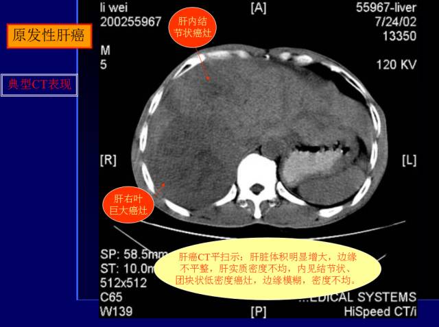【PPT】常见肝胆胰腺疾病的CT(全)