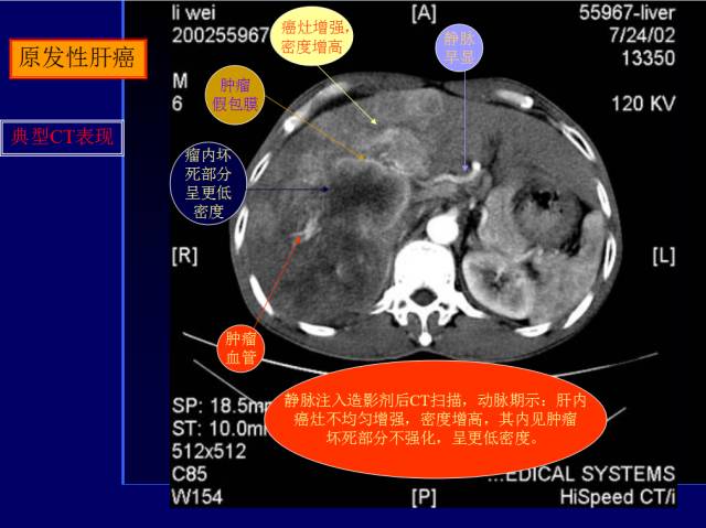 【PPT】常见肝胆胰腺疾病的CT(全)