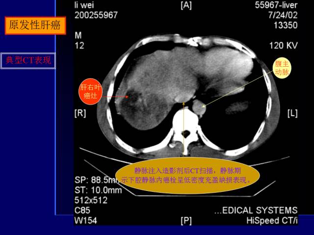 【PPT】常见肝胆胰腺疾病的CT(全)