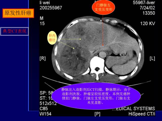 【PPT】常见肝胆胰腺疾病的CT(全)