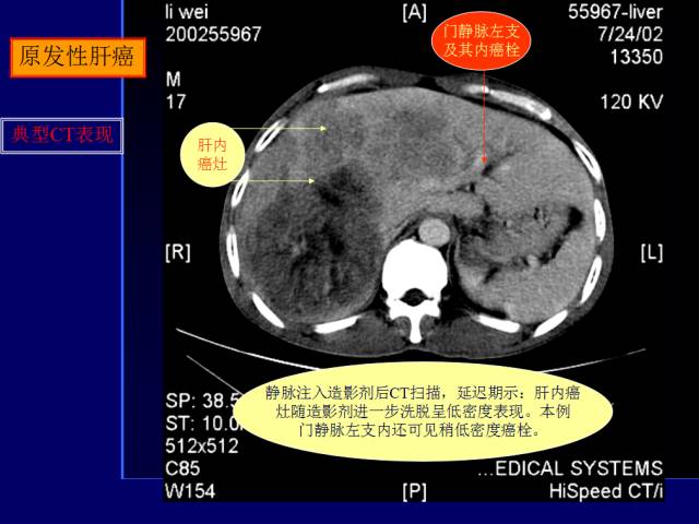 【PPT】常见肝胆胰腺疾病的CT(全)