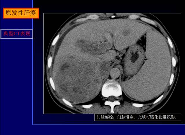 【PPT】常见肝胆胰腺疾病的CT(全)