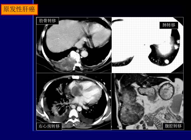 【PPT】常见肝胆胰腺疾病的CT(全)
